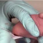 Nguyên tắc sàng lọc sơ sinh và kỹ thuật lấy máu gót chân