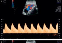 ISUOG Practice Guidelines (updated): use of Doppler velocimetry in obstetrics