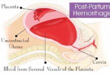 Thử nghiệm lâm sàng ngẫu nhiên về chẩn đoán và điều trị sớm chảy máu sau đẻ